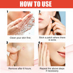 Liveify acne patch usage guide: clean skin, apply patch, remove after 6 hours, repeat as needed