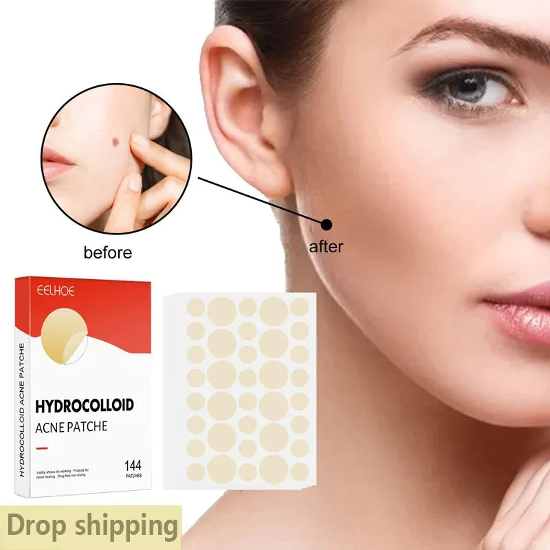 Liveify hydrocolloid acne patches in beige, 144-count box with before/after skin results shown