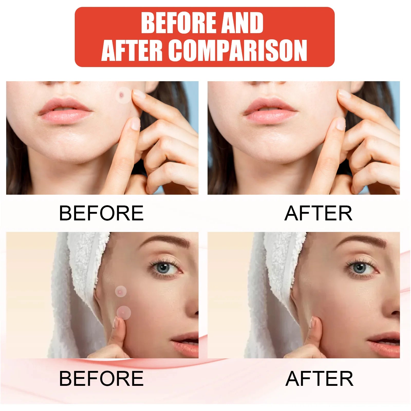 Liveify before and after comparison showing clear skin results with acne treatment, featuring smooth complexion and reduced blemishes